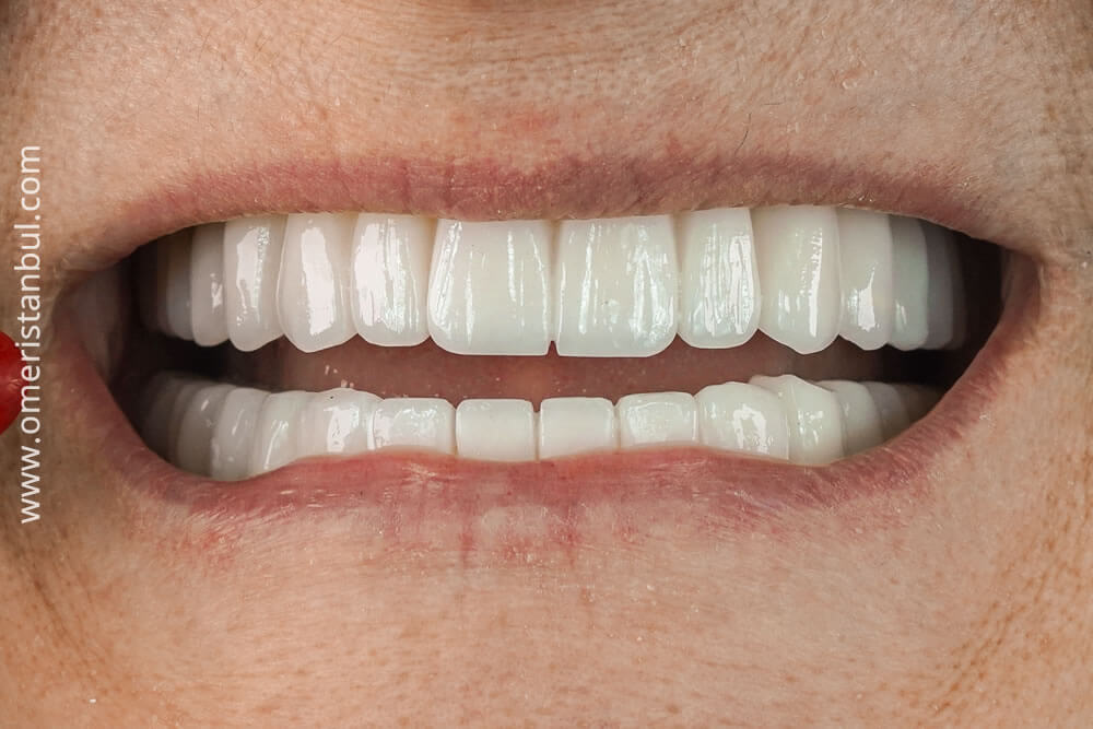 Зубной имплант